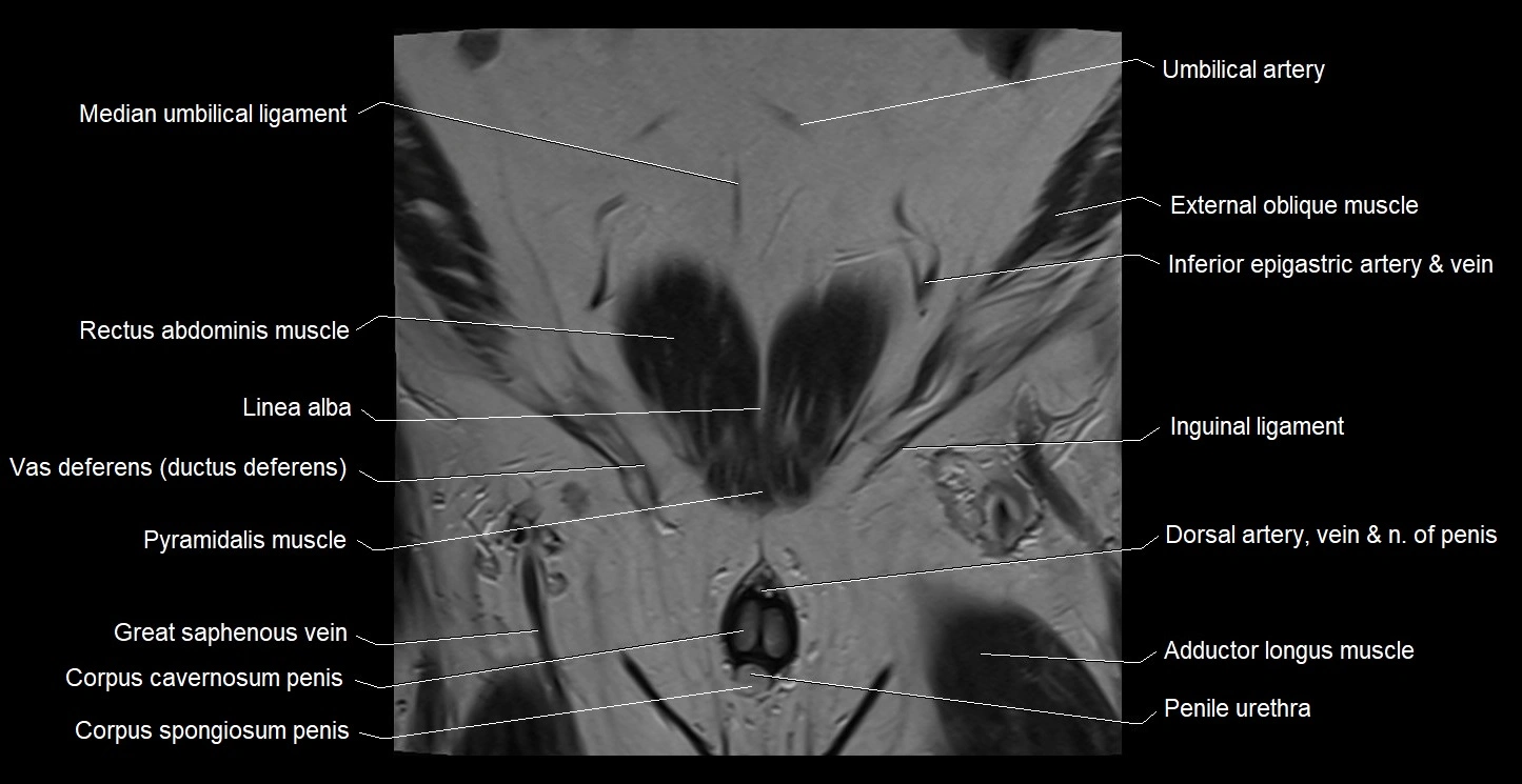 MRI coronal cross sectional anatomy male pelvis image 5.webp